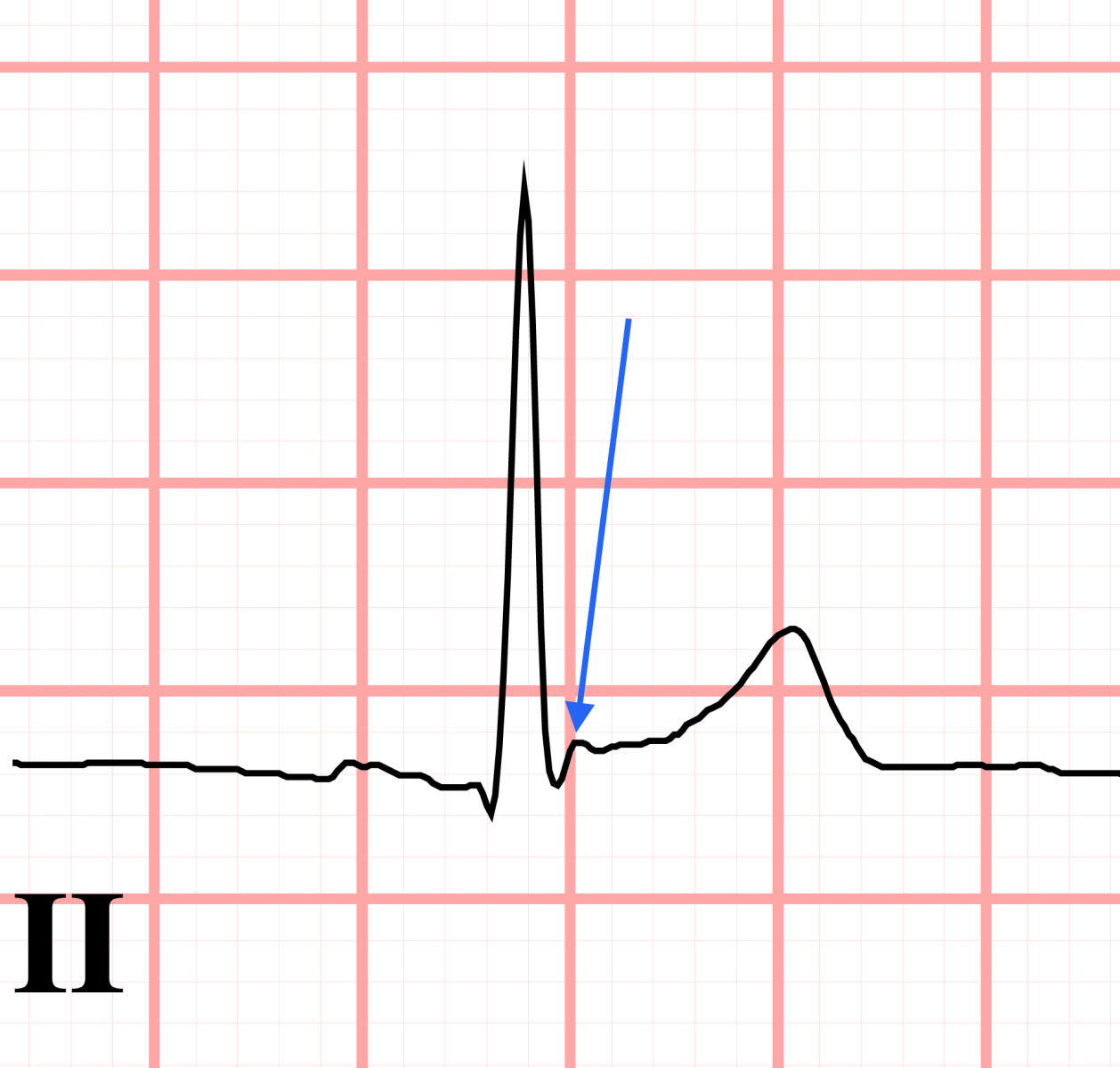 terminal-qrs-slurring